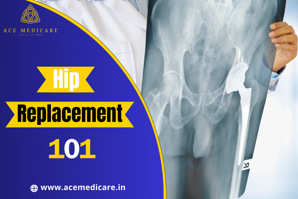 Hip Replacement 101: Understanding the Procedure and Recovery Process
